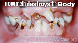METH MOUTH